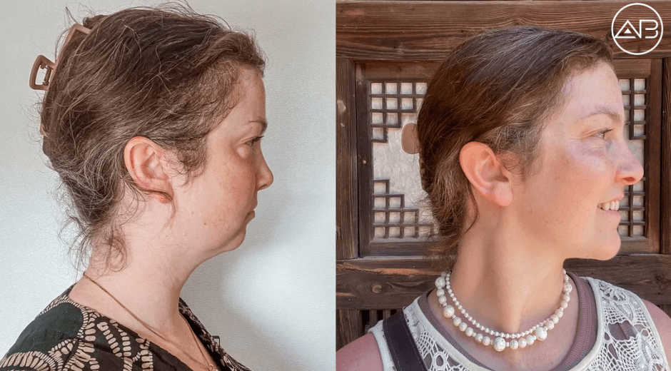 One Year After Cosmetic Surgery in Korea: The Honest Update Nobody Talks About