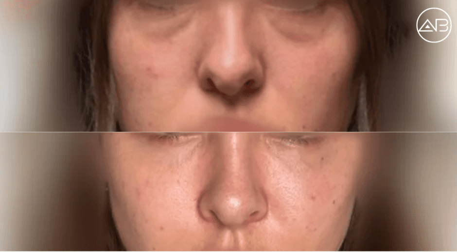 My experience of facial fat grafting/repositioning South Korea, Seoul