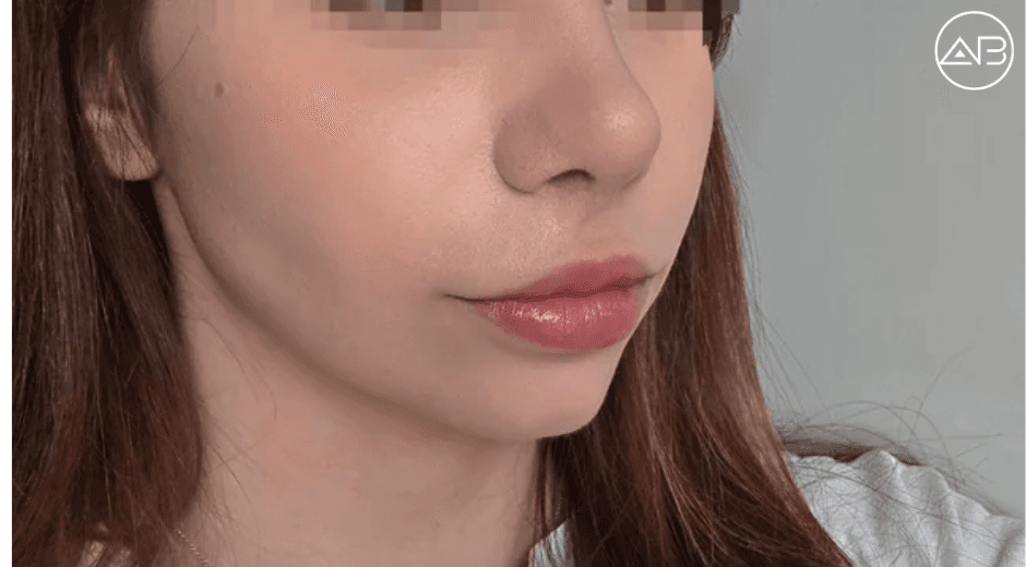 Rhinoplasty and fatgraft at AB clinic