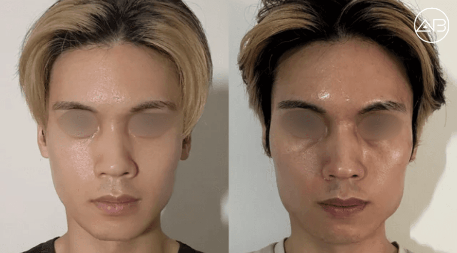 3set contour + fat grafting/repositioning 6 month update