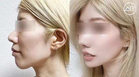 Say goodbye to a long face! A real-life report on 3 points for facial contouring that led to compliments on a beautiful V-line