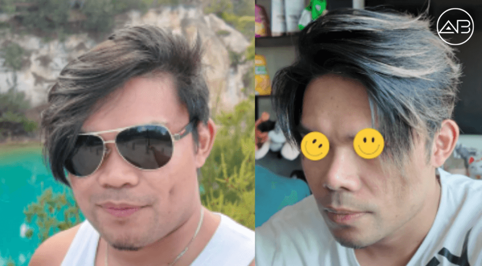9 months post-op rhinoplasty (AB plastic Surgery)