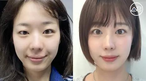 Natural-looking double eyelids... I'm extremely satisfied with the result.