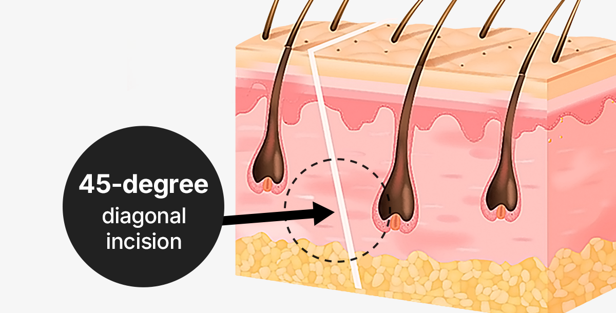 45-degree diagonal incision