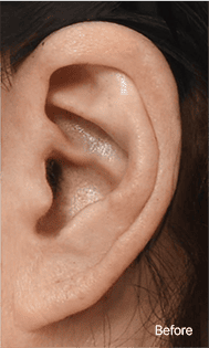 Skill matters in post-surgery scarring too. 1