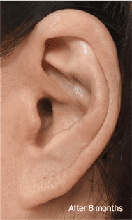 Skill matters in post-surgery scarring too. 3