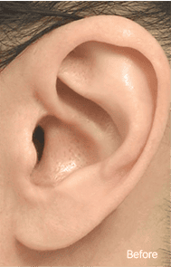 Skill matters in post-surgery scarring too. 1