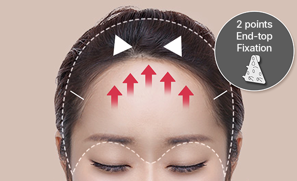 Forehead Lift (Endotine) | Anti-aging | AB Plastic Surgery Korea