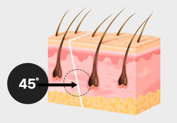 Diagonal incision