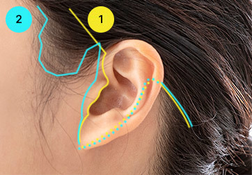 Personalized design without ear shape deformation.