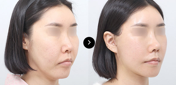 Semi-Face Lifting 이미지 2