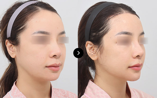 Mini Incision Face Lifting 이미지 2