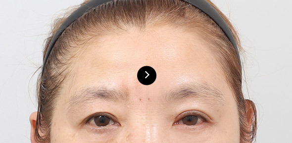 Endoscopy Forehead Lifting 이미지 3