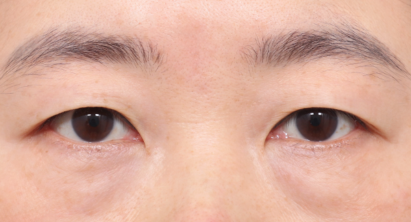 Eyes with overall drooping of the eyelids that require upper blepharoplasty