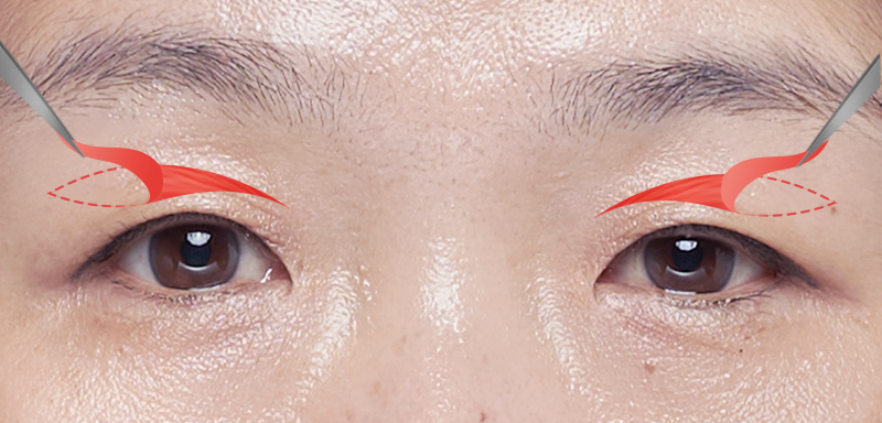 Removal of an appropriate amount of eyelid skin, fat, and muscle.