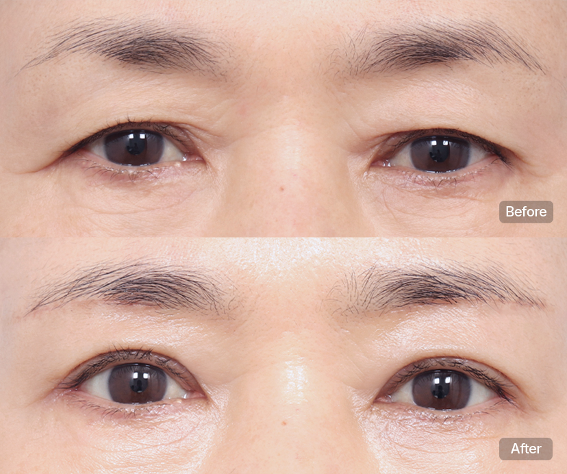 blepharoplasty korea