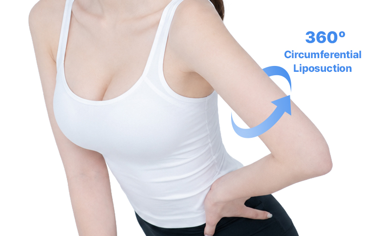 360-degree circumferential arm liposuction