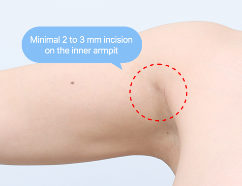 Minimal 2 to 3 mm incision on the inner armpit