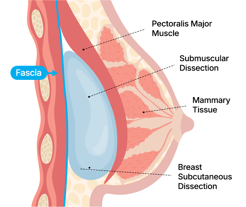 Dual-plane surgical method 