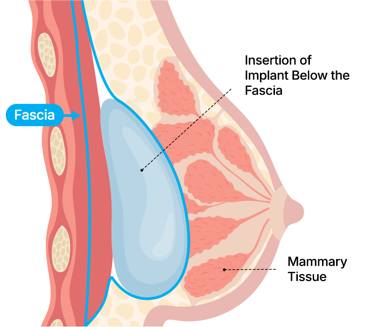 Subfascial insertion surgery