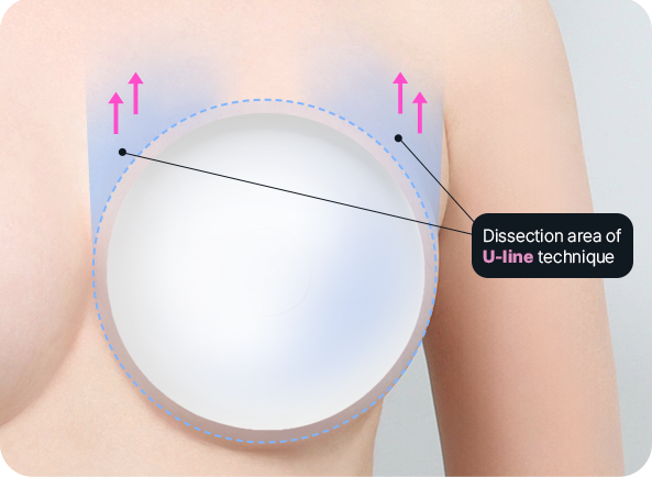 Ab Surgery