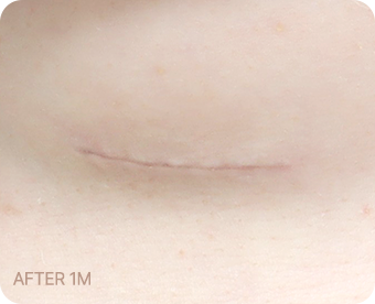 Ab Surgery
