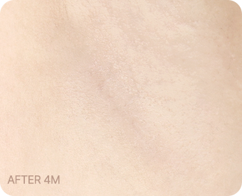 Ab Surgery
