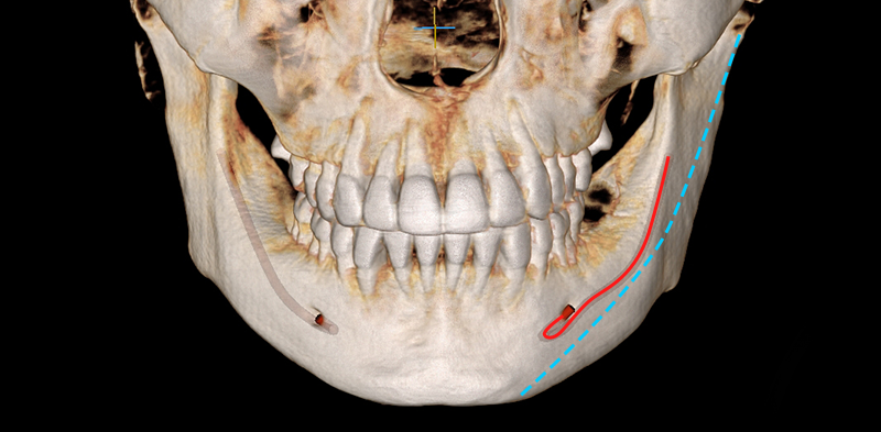 Long Curved Resection to Prevent Secondary Angle