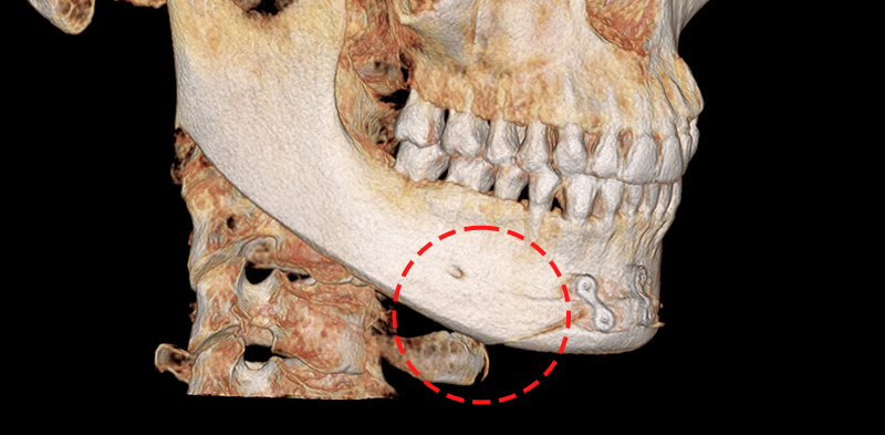 Long Curved Resection to Prevent Secondary Angle