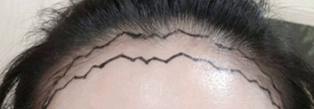 Zigzag Incision Line Design