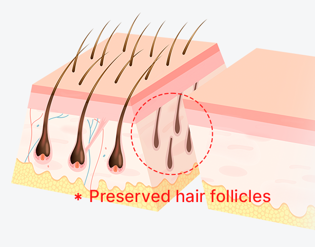 Preserving Hair Follicles with a 45-Degree Angled Incision