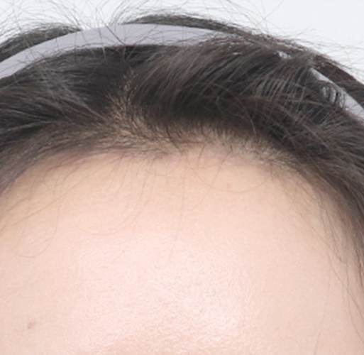 Preserving Hair Follicles with a 45-Degree Angled Incision