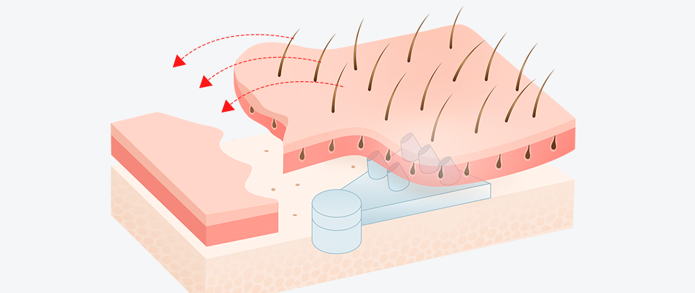 Clear Effect Through Scalp Advancement 