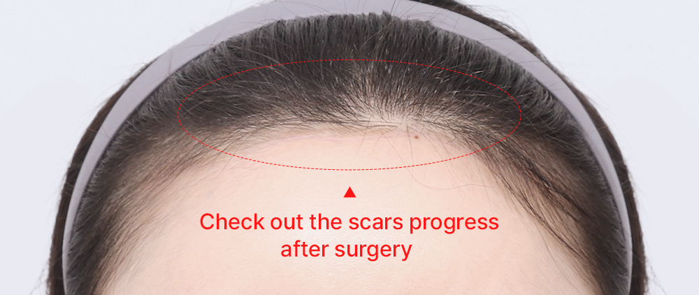 Clear Effect Through Scalp Advancement 