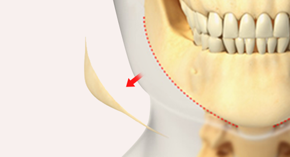 Long Curved Resection to Prevent Secondary Angle