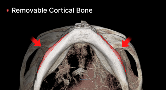 Cortical Bone Resection for Frontal Effect