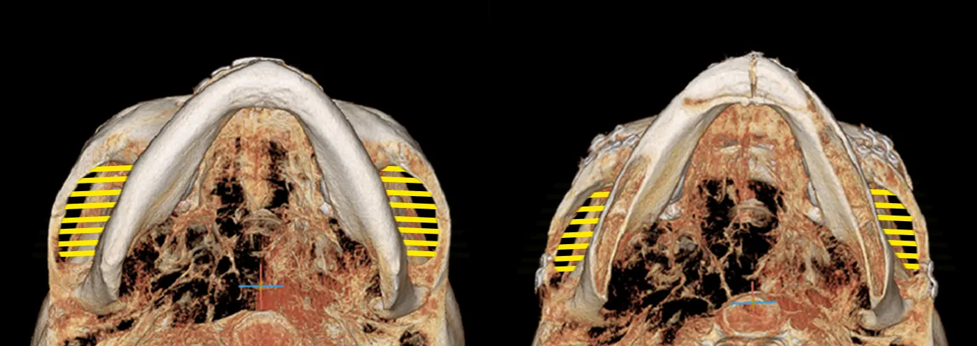 맥미걸 악플콜렉터 수술 전후 ct 사진