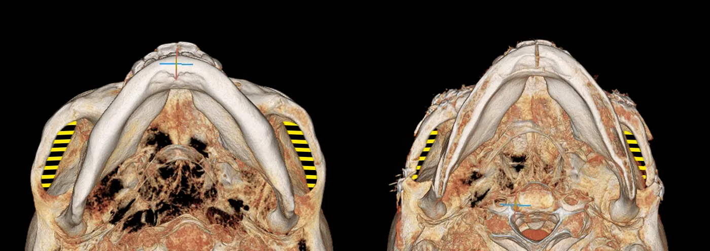 맥미걸 악플콜렉터 수술 전후 ct 사진