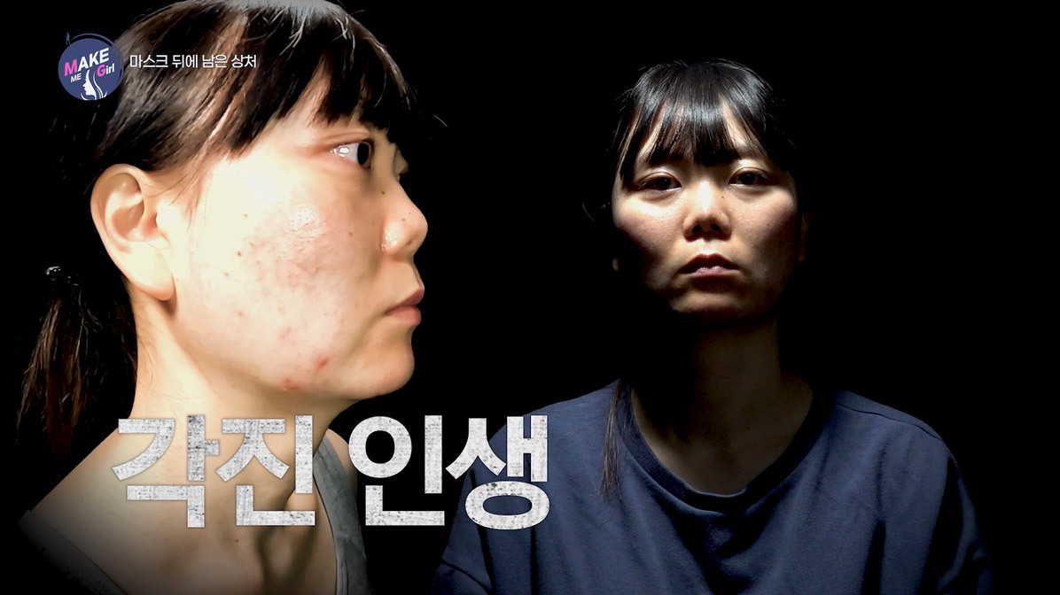 맥미걸 MAKE ME GIRL 수술 전