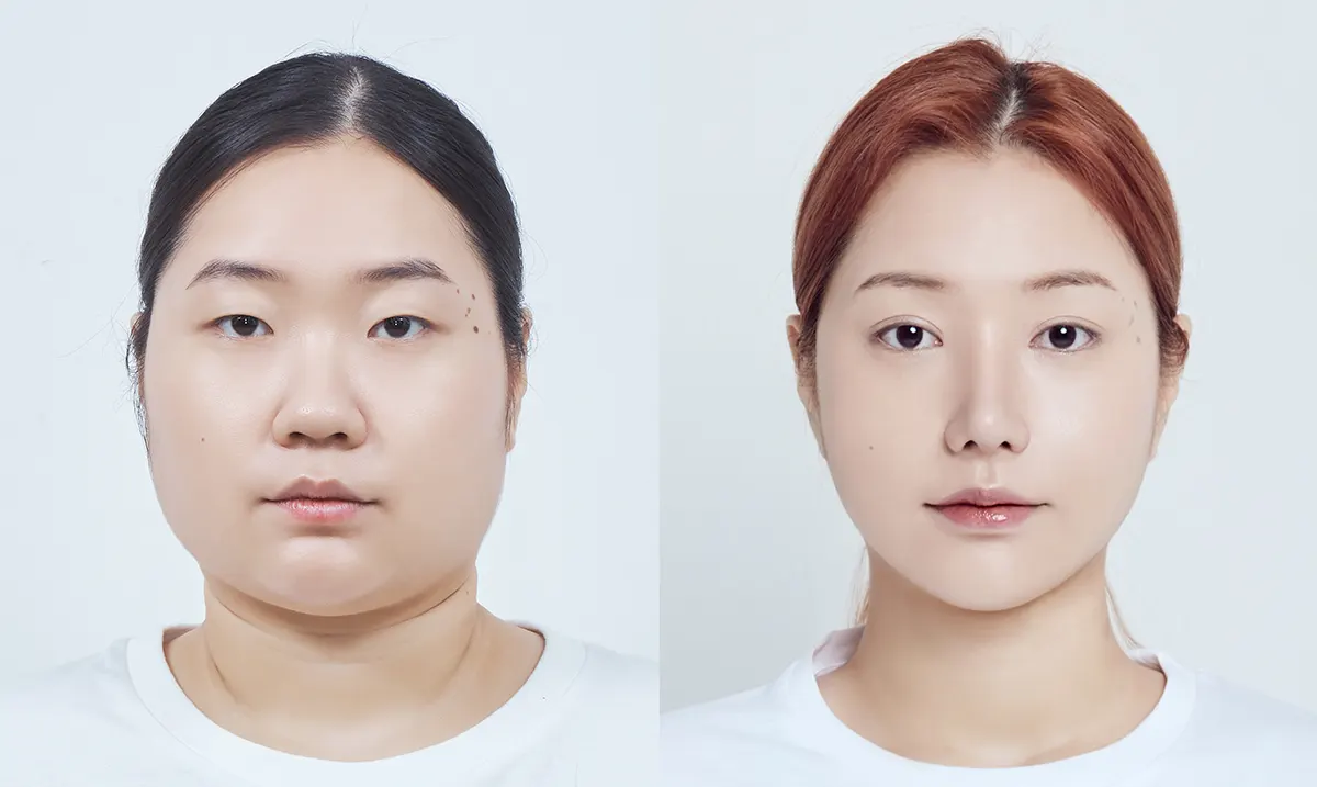 맥미걸 악플콜렉터 수술 전후 의학 사진