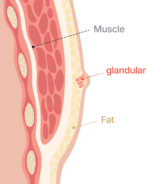 Gynecomastia surgery