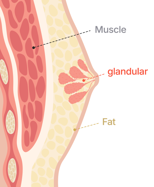 Gynecomastia surgery