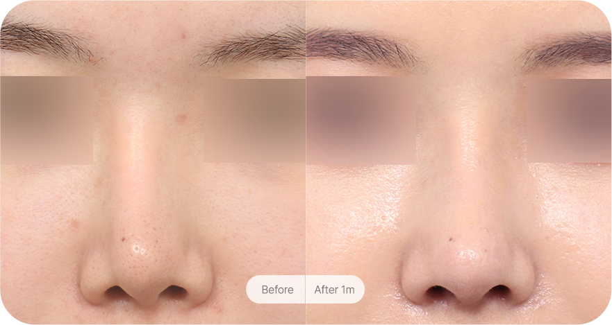 revision-rhinoplasty