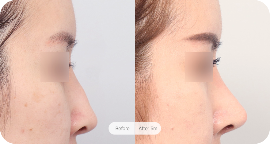 revision-rhinoplasty