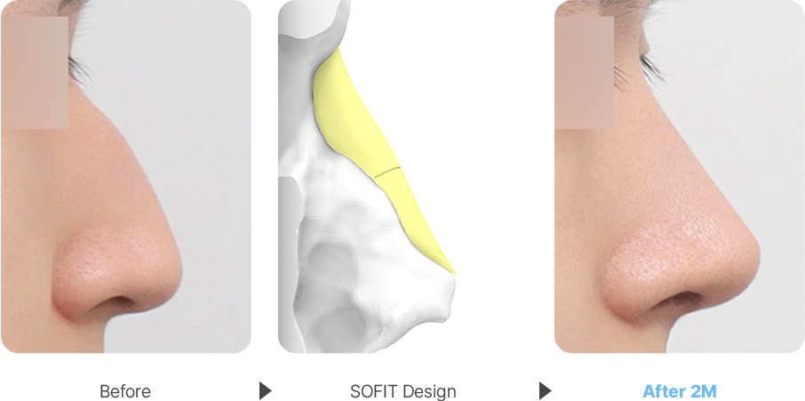 Severe Hump case