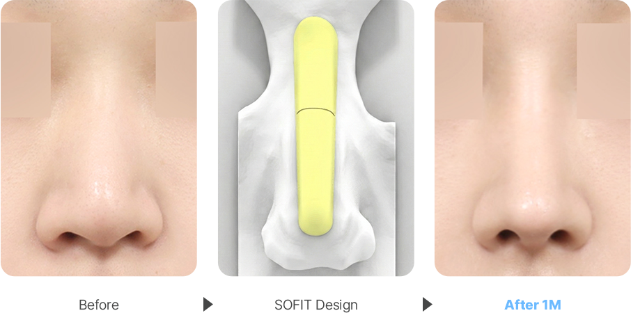Deviated Nose case