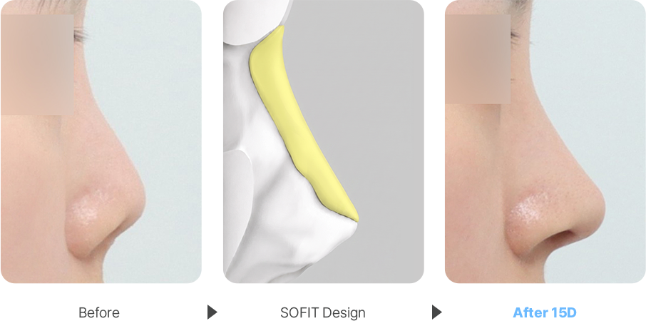 Contracted Nose case