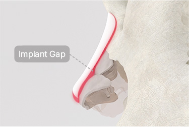 Conventional Rhinoplasty