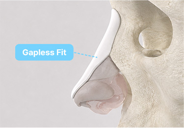 3D Customized Rhinoplasty, SOFIT
