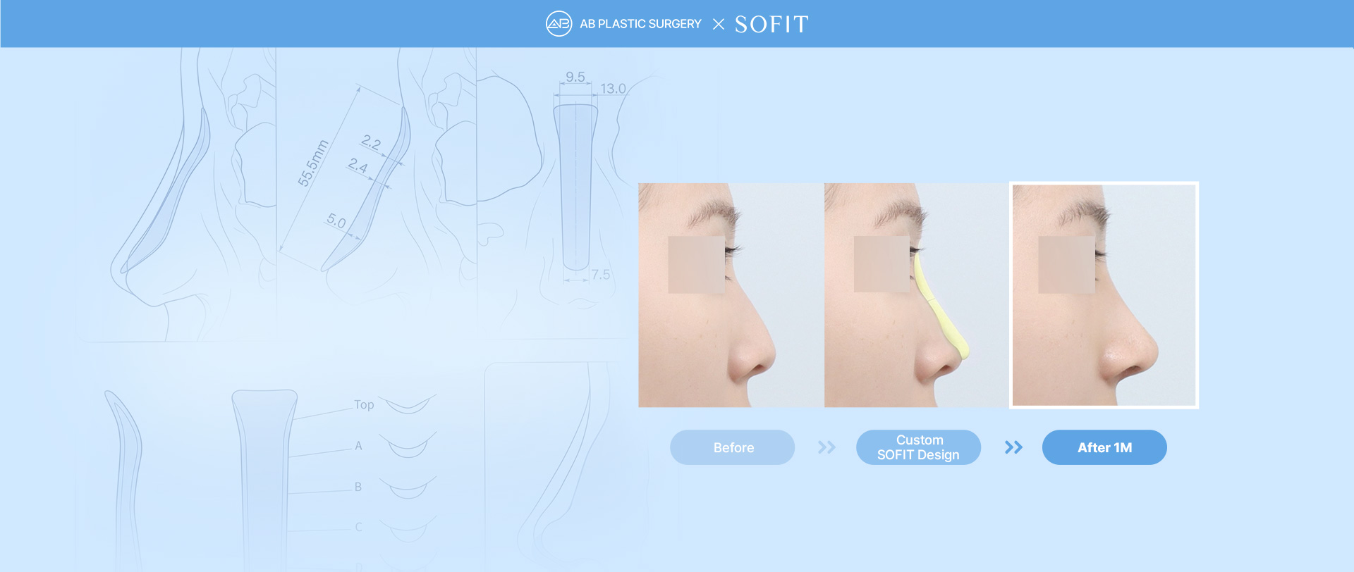 Sofit Nose